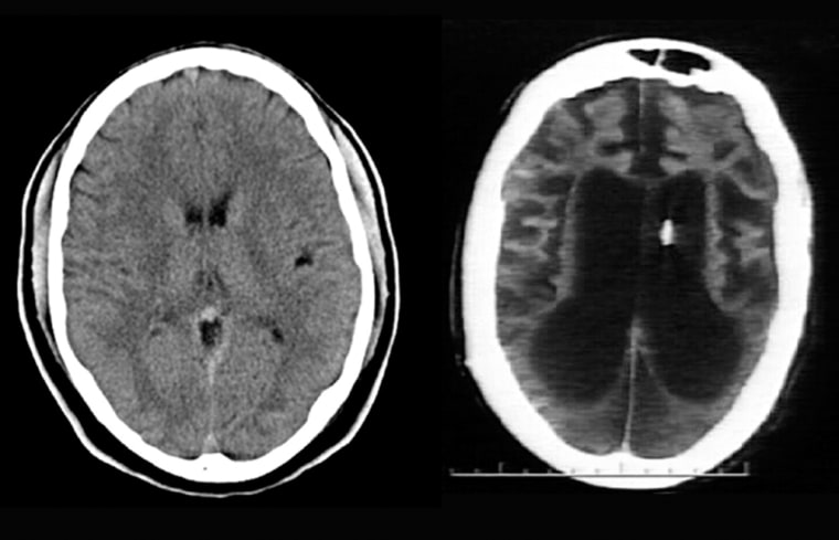 (Left) CT scan of a normal 25 year old; Right, Terri Schiavo's most recent scan