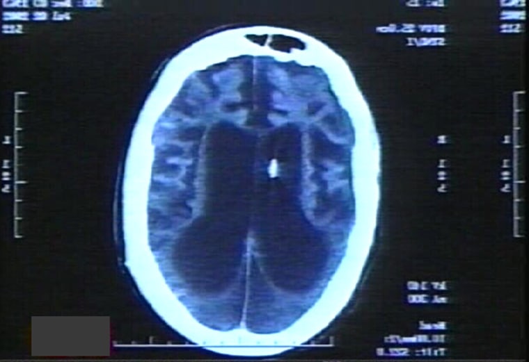 Terri Schiavo's 2002 CAT scan. Ronald E. Cranford, M.D., who examined her in 2002, provides this  scan of Schiavo's brain. Crawford is assistant chief of neurology at the Hennepin County Medical Center.