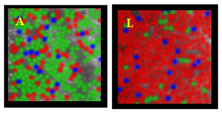 These color-coded images of living human retinas show the wide diversity in the number of cones sensitive to different colors. The image on the left shows the retina of a person who has few red-sensing cones, and the one on the right is of someone with far more red cones. The pictures are blurry because that's the best the new imaging process could manage.