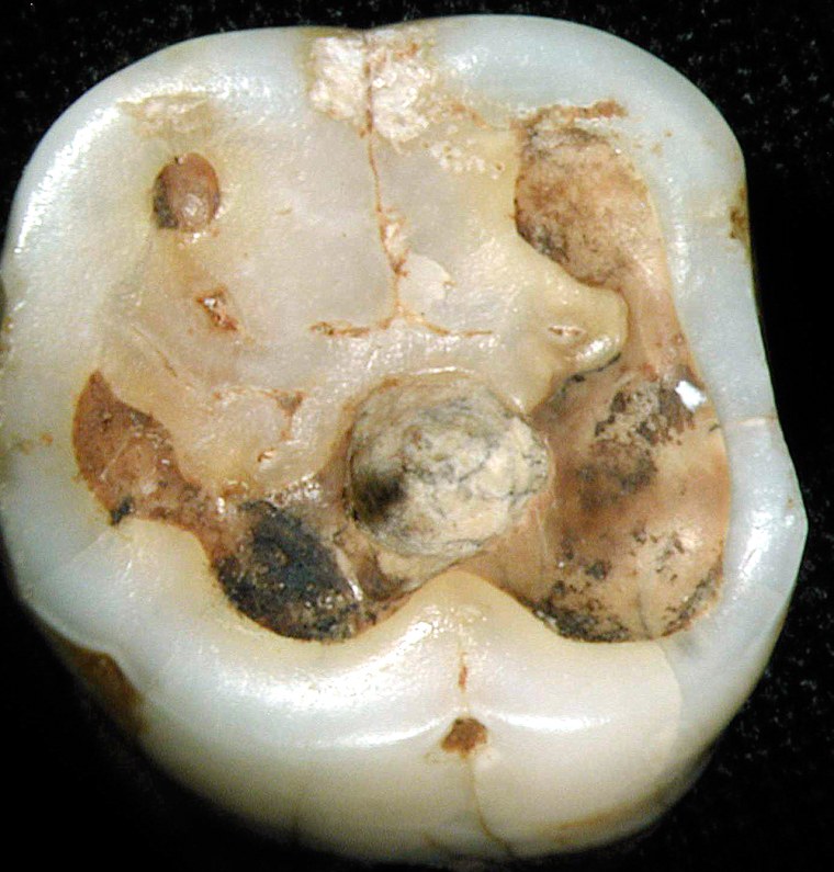 ** HOLD FOR RELEASE UNTIL 1 PM EDT WEDNESDAY APRIL 5, 2006 ** These 2001 images released by Nature show drilled molar crowns from a 7000-9000 BP Neolithic graveyard in Mehrgarh, Pakistan. At top, the back edge of a lower first right molar and bottom, the occlusal (chewing) surface of a lower right first molar with a large hole (2.6mm wide, 2.2mm deep) in the center of the crown. The hole has been enlarged by another tool and shows smoothing, indicating  it was drilled well before the death of the individual. (AP Photo/Luca Bondioli, Pigorini Museum, Rome)