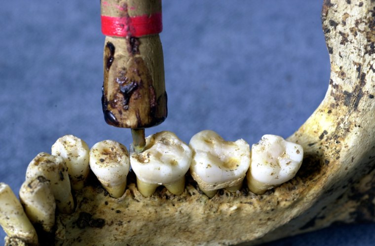 Researchers conduct a re-enactment of the method presumably used in Pakistan to drill teeth 9,000 years ago. A flint drilling tip was mounted in a rod holder and attached to a bowstring. In less than a minute, the technique produced holes similar to those found in prehistoric teeth. One important difference: The Neolithic dentists performed their operations on living humans.