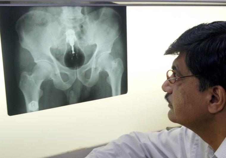 Dr. Aftab Ahmed reads an X-ray of prison inmate Fateh Mohammad at a hospital in Multan, Pakistan, on Wednesday.