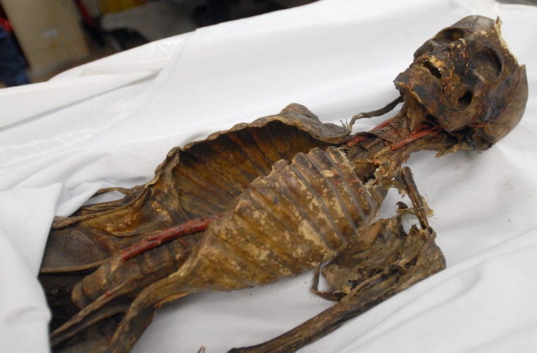 Mummified skeletal remains sit on an examining table at Port Huron Hospital in Port Huron, Mich. The Port Huron Police confiscated the remains from a woman's home Wednesday after getting a tip that someone was selling the remains on eBay. 
