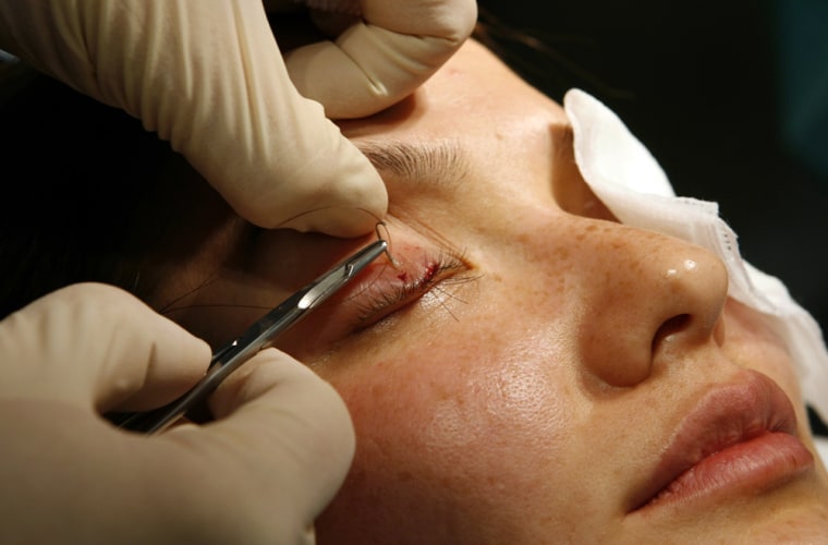 Doctor sews eyelash transplants into woman's eyelids to make her lashes longer during surgery in Los Angeles