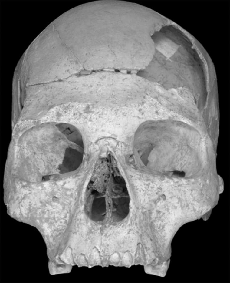 This skull, found in Pestera cu Oase — the Cave with Bones — in southwestern Romania, includes features of both modern humans and Neanderthals, possibly suggesting that the two hominid species may have interbred thousands of years ago.