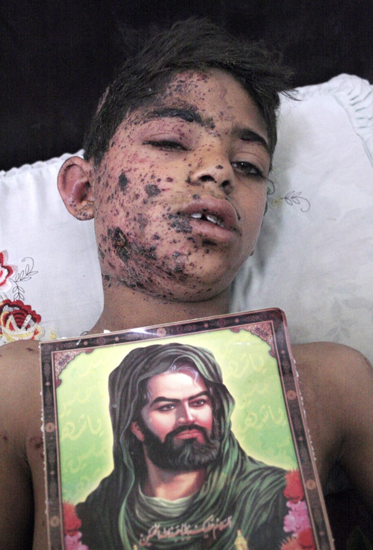 An Iraqi boy named Haidar (12), injured