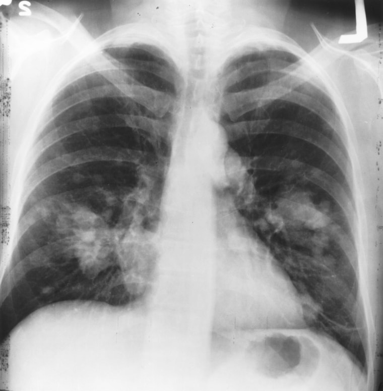 Image: An x-ray image of a chest