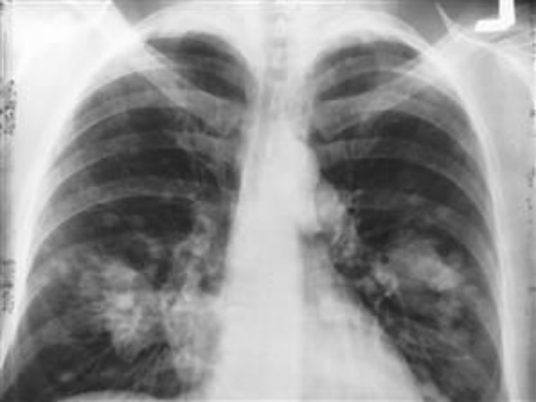 Lung cancer x-ray