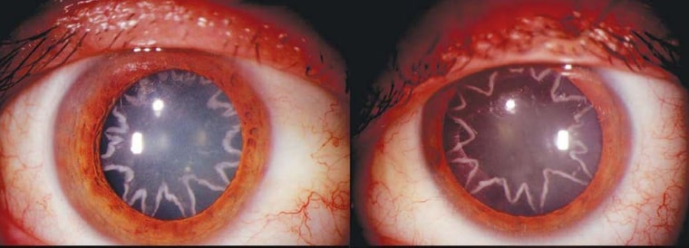 Image: After an electrical burn, a man developed star-shaped cataracts in his eyes.