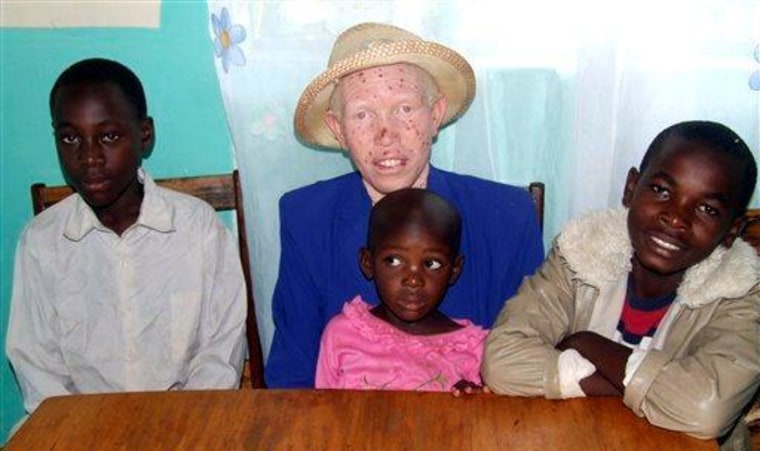 Image: Albino mother and dark-skinned children