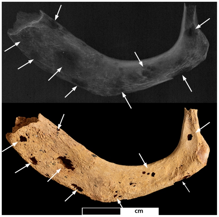 Image: Photo and radiograph of left first rib of ancient skeleton