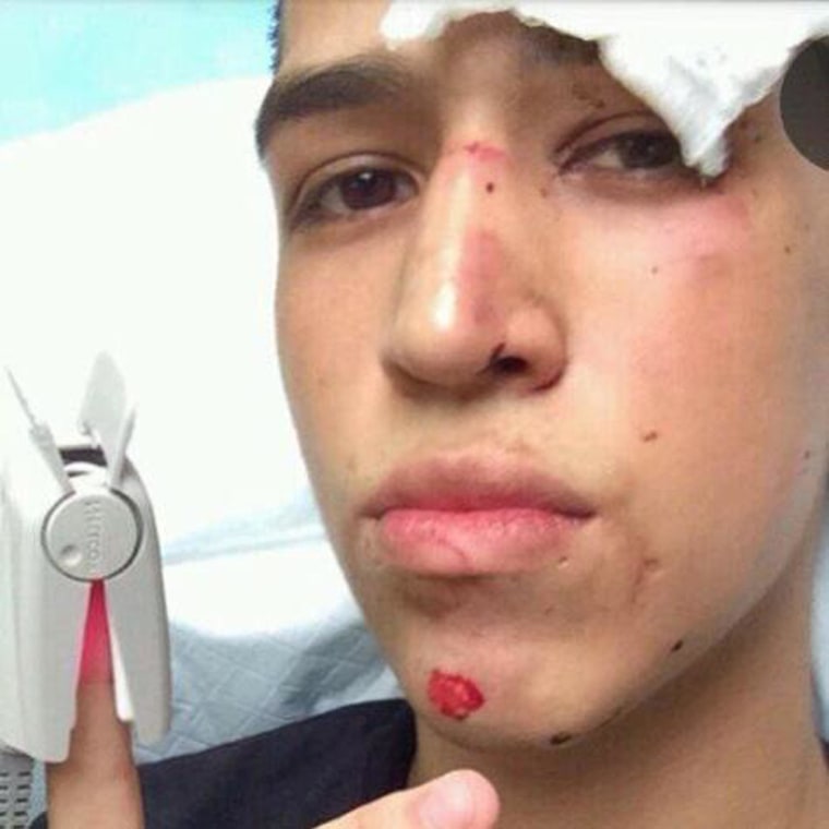 California Bus Crash: Survivor Snapchats From Hospital Bed