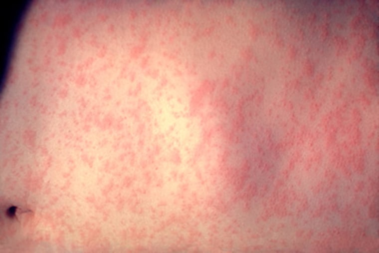 Here's what measles looks like, three days after infection. The U.S. is seeing a surge in cases, including many tied to unvaccinated travelers who bring the disease back to unvaccinated people at home.
