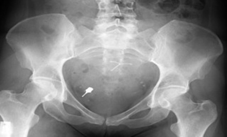 An X-ray reveals a dental implant screwdriver swallowed by a patient.