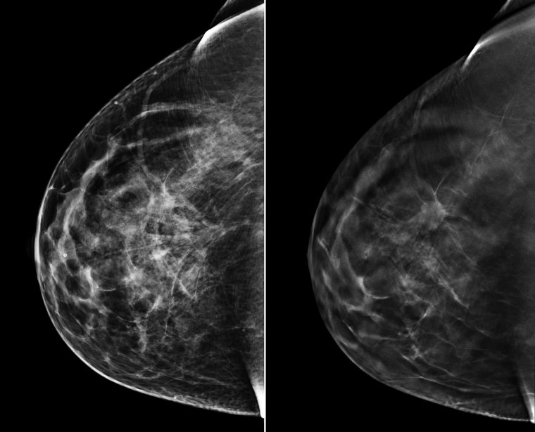 On the left is a traditional 2D mammogram. On the right is 3D tomosynthesis.