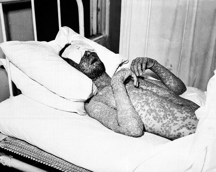 Image: A man who has contracted smallpox 