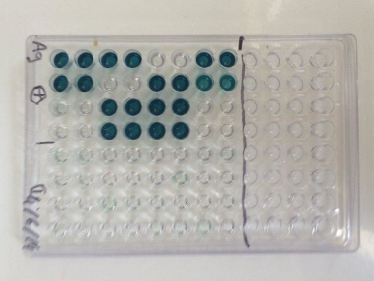 Image: A test showed that patients who had mysterious fevers in Sierra Leone in 2006 in fact had Ebola. The  color indicates antibodies to Ebola.