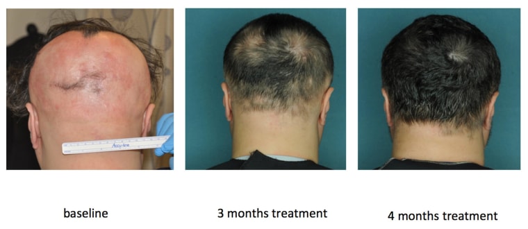 Image: The effect of an FDA-approved drug that restored hair growth in a research subject with alopecia areata