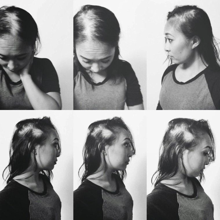 An updated series of selfies by Jackie Nguyen, as her hair continued to fall out after her alopecia diagnoses.