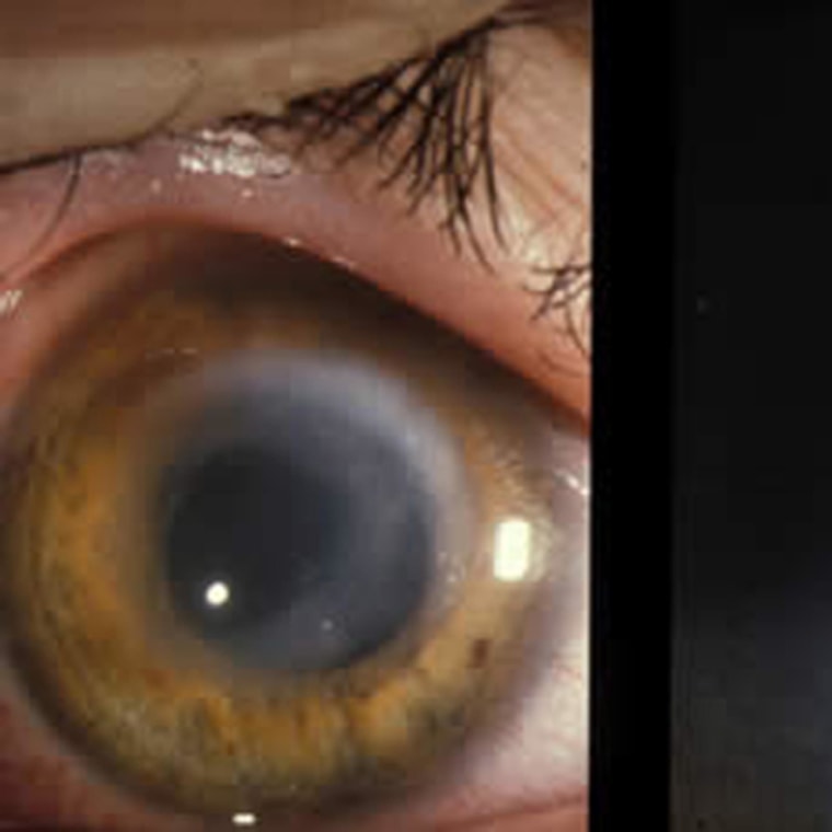 Image: Contact lens wear is linked to higher risk of keratitis