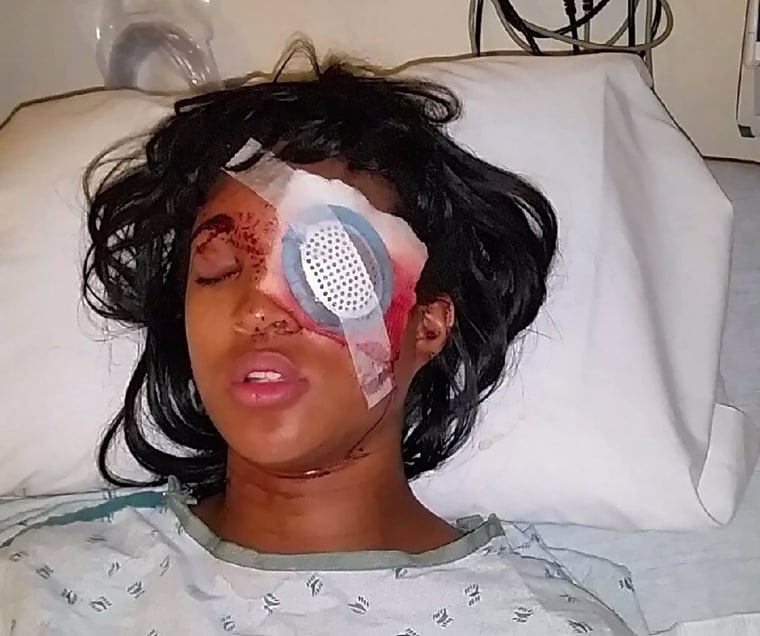 Dornella Conner, 24, was injured Tuesday after police in St. Louis shot her in the face with a bean bag round, blinding her in her left eye.