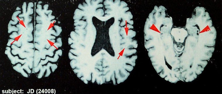 Image: chronic traumatic encephalopathy