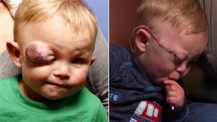 Colby Ramos-Francis was at risk for blindness from a giant tumor on his eyelid (R). This week, a group of plastic surgeons removed the tumor (L) and saved the toddler's vision, at no cost.