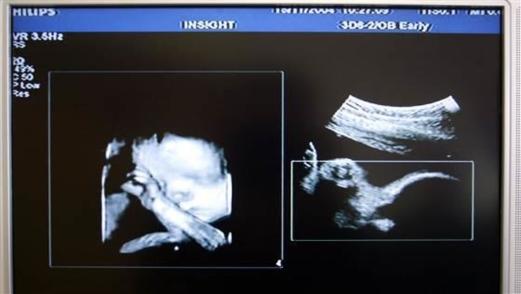 This file photo shows a 3D ultrasound image of an unborn child.