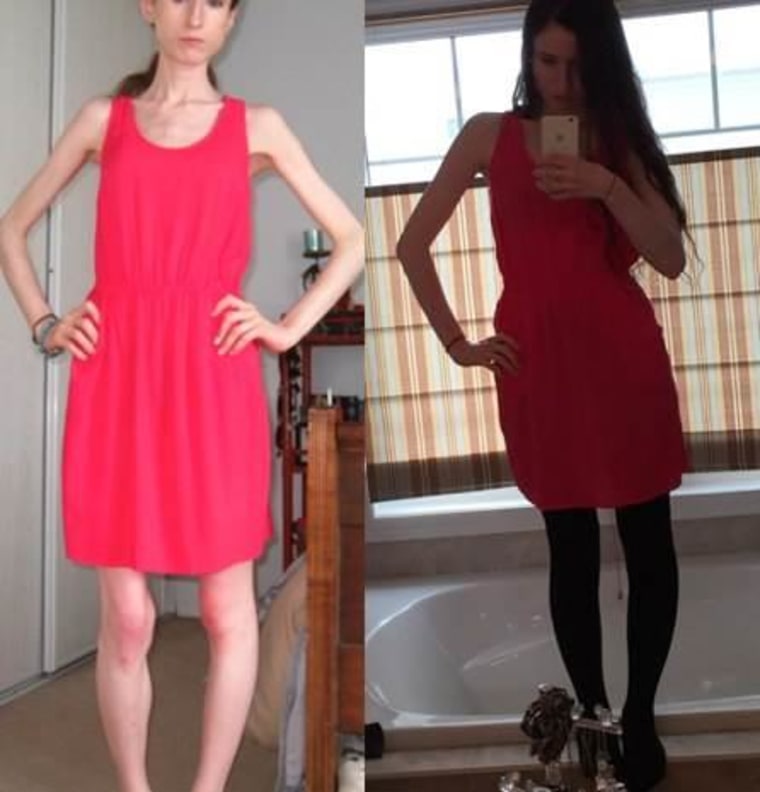 Brave Anorexia Survivor Posts Shocking Recovery Photos On Weight Loss 