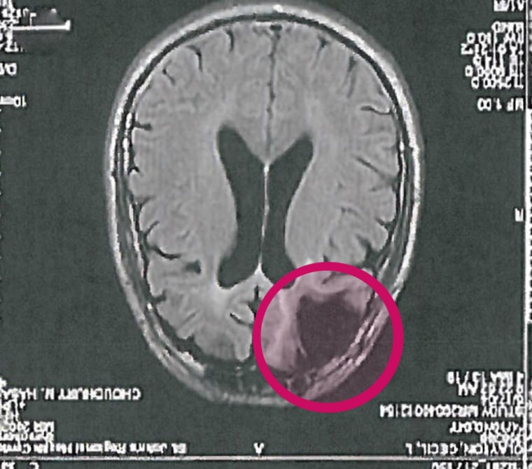 A brain scan shows the missing portion of Cecil Clayton’s brain. Clayton suffered brain damage in a sawmill accident that required one-fifth of his frontal lobe to be removed. He is scheduled for execution in Missouri.