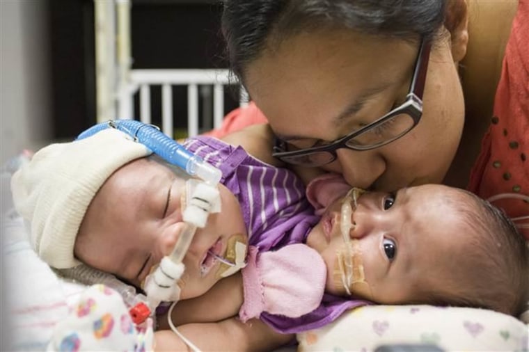 Mom Elise Mata holds her conjoined twin girls in the neonatal intensive care unit as they await separation surgery.