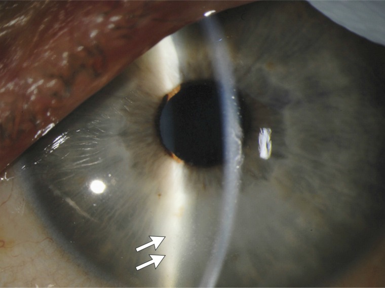 Image: Slit-Lamp Photograph of the Left Eye 14 Weeks after the Onset of Ebola Virus Disease