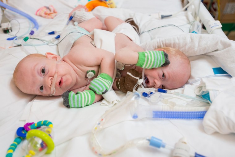 Image: Five-month-old conjoined twins Carter and Conner Mirabal