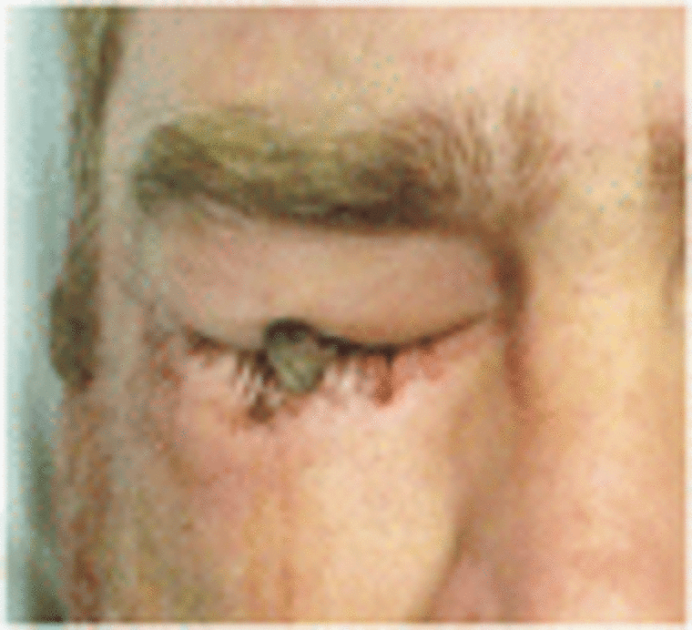 A nail was clearly protruding from the patient's eye