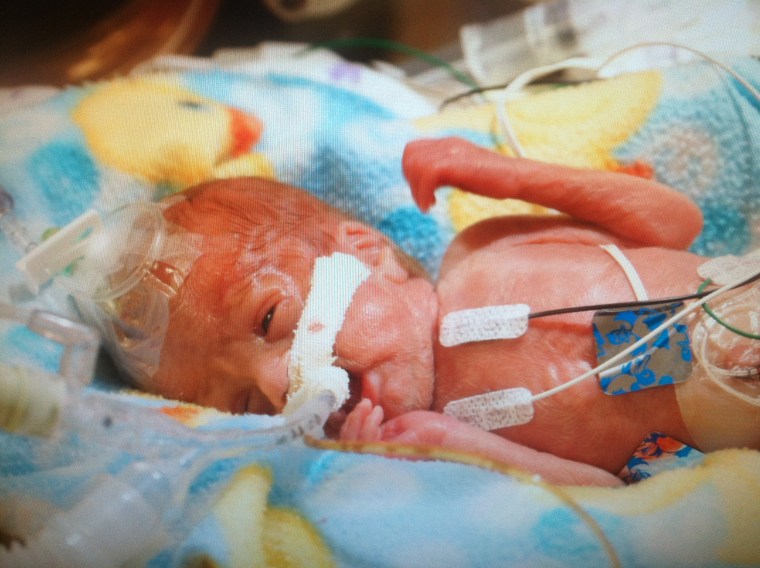 Trevor needed life support when he was born at 23 weeks gestation in August 2014.