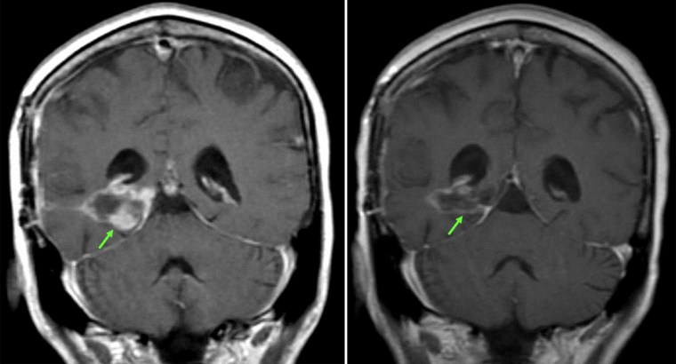 MaryAnn Anselmo of Morganville, N.J. was told she would die of her gliomlastoma brain cancer but a melanoma drug helped her. These images show how it erased her tumor. The image on the left is before treatment, the image on the right, is after.