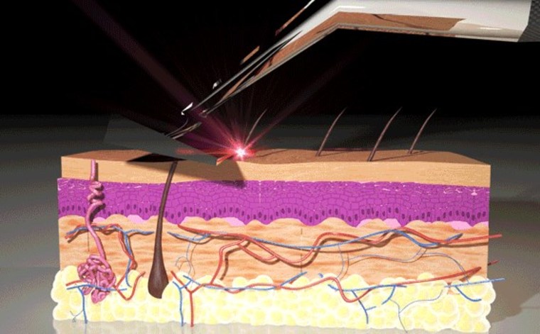 Still from an animation showing how the Skarp zaps hairs it comes in contact with.