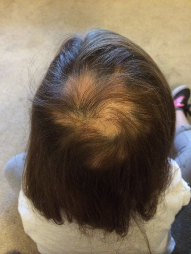 Ellie Regal, at 6, just beginning to lose her hair.