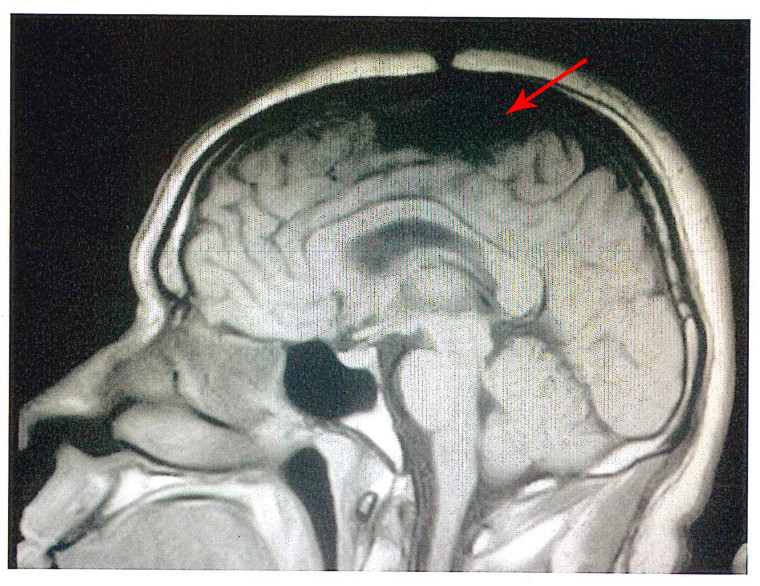 Image: a scan of Ernest John’s brain showing a hole in his skull and brain missing