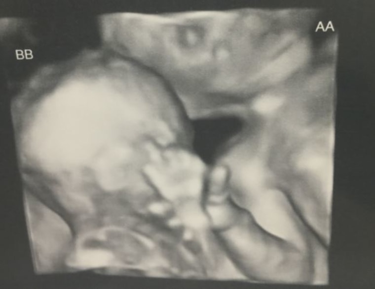 This 20-week ultrasound shows Jami Cavanagh's twins, perfectly healthy and holding hands. Three days later, Twin To Twin Transfusion Syndrome claimed one twin's life and left the other in critical condition.