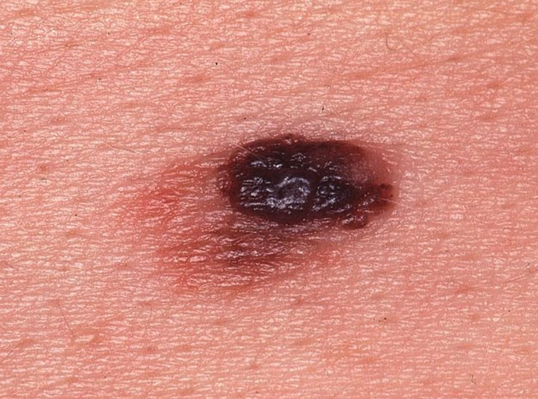Image: A cancerous mole  