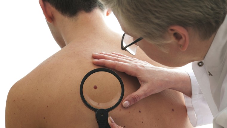 A Generic Photo of a doctor examining a mole which could be skin cancer.