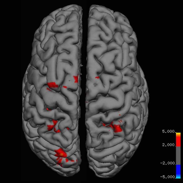 Image: Cerebral areas where the “Christmas group” had a significantly higher increase in cerebral activity than the “non-Christmas group”