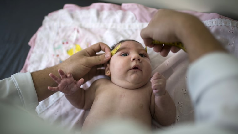 Baby in Brazil born with microcephaly