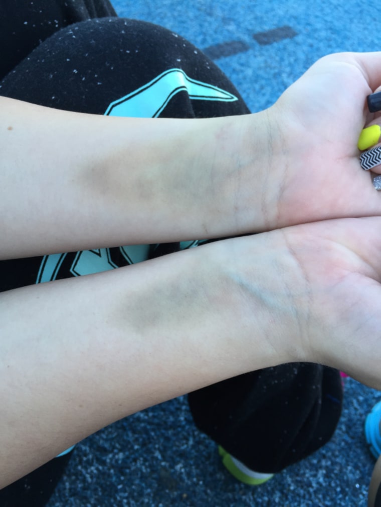 "Bruises from blood tests during my hospital stay," Lottritz writes. "This picture was taken several days after I was discharged from the hospital."