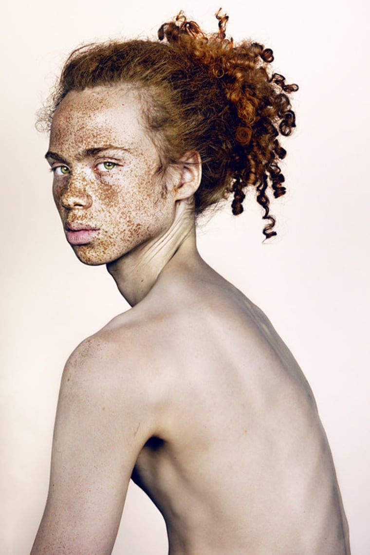 Brock Elbank says he hopes his participants see the beauty in their freckles.
