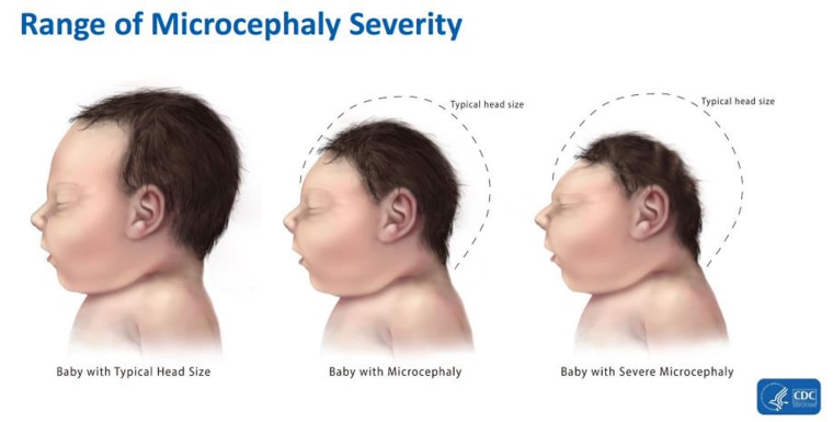 It's Official: Zika Virus Causes Birth Defects