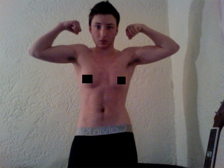 Ashton Colby, age 21, after five months on testosterone and before his double mastectomy.