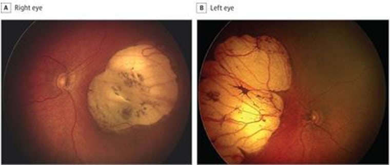 Image: Zika Eyes Abnormality