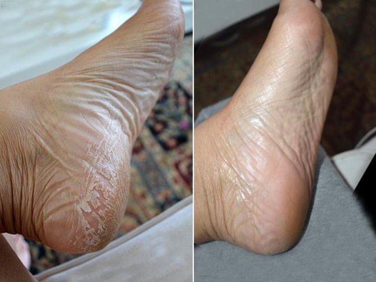 baby foot peel before and after